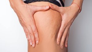 Stadi della cellulite: quali sono e come rimediare